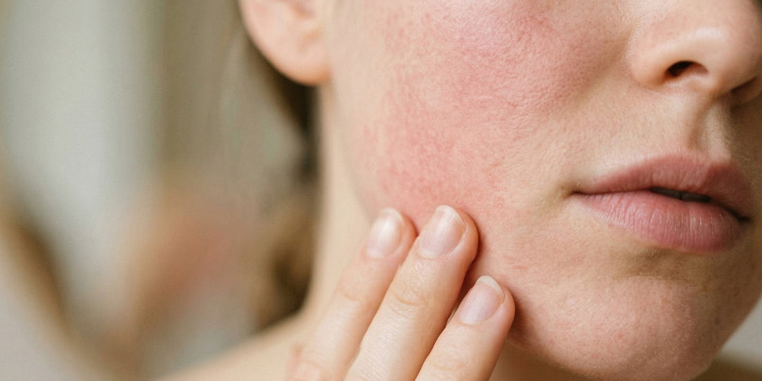 Close-up of a person's face with visible skin texture and redness.